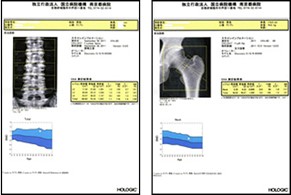 骨密度測定DEXA（Dual Energy X-ray Absorptionmetry）