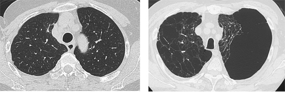 図1．非喫煙者(左)と喫煙者(右)の肺CTスキャン