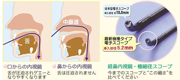 イラスト：口・鼻に内視鏡を入れた場合のイメージ図と経鼻胃内視鏡の写真